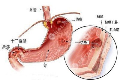 胃溃疡的原因