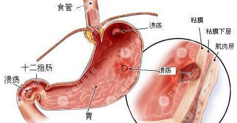 福州治疗糜烂性胃炎的医院那家好