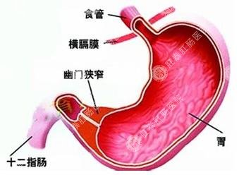 如何预防胃息肉,胃息肉的护理措施