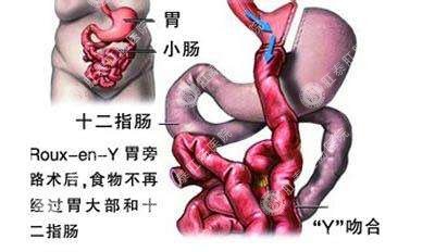 十二指肠溃疡