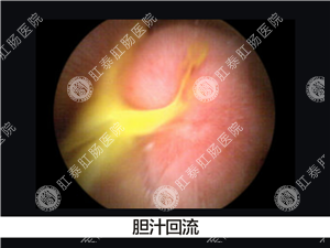 治疗反流性胃炎哪家医院好