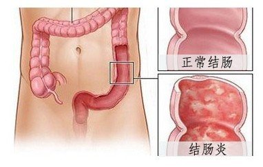  福州那家医院治疗结肠炎专业