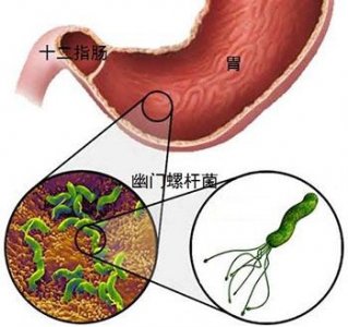 福州哪个专业医院治幽门螺杆菌医院好