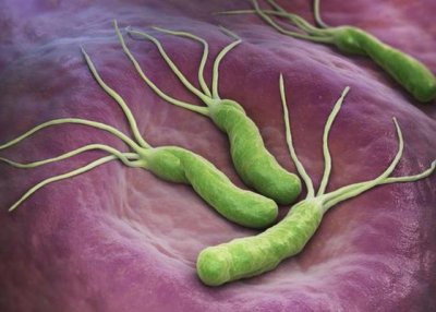 幽门螺旋杆菌的危害和治疗方法